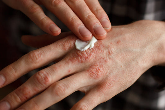 Tallow Skincare: Your Secret Weapon Against Eczema and Big Beauty Bull